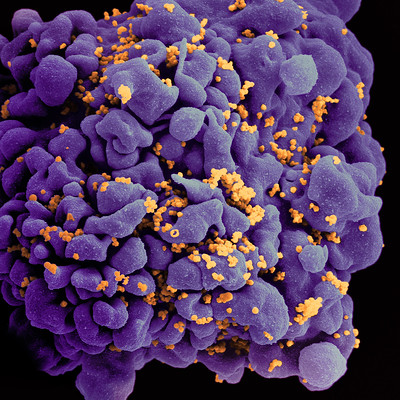 HIV-infizierte T-Zelle